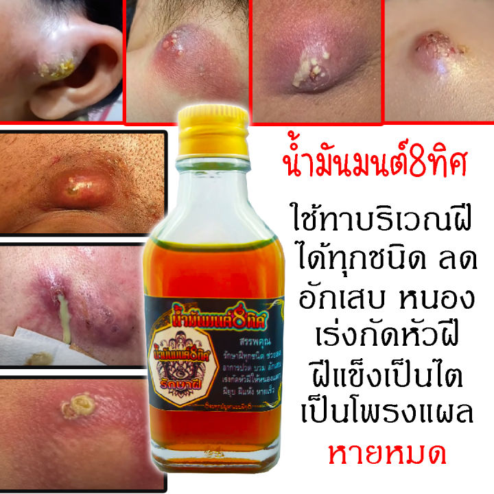 น้ำมันทาสำหรับนวดกัดหัวฝี-น้ำมันมนต์8ทิศ-กัดหัวฝีหนองอักเสบทุกชินด-สมานแผลปิดโพรงฝี-หนองแตกดูดหัวฝี-เร่งกัดหัวฝีทุกชนิด2-3วัน