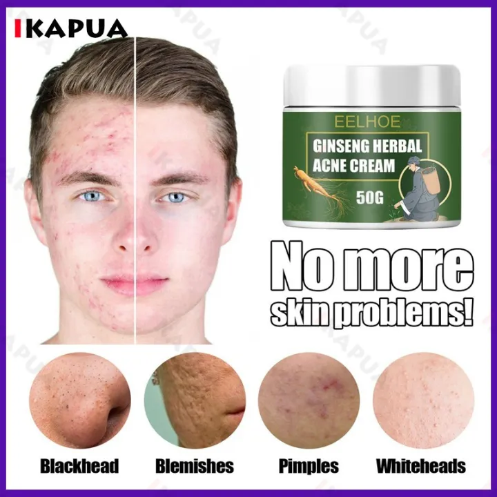Acne Cream Ginseng Herbal Pimple Remover Acne Marks Remover Skin Care