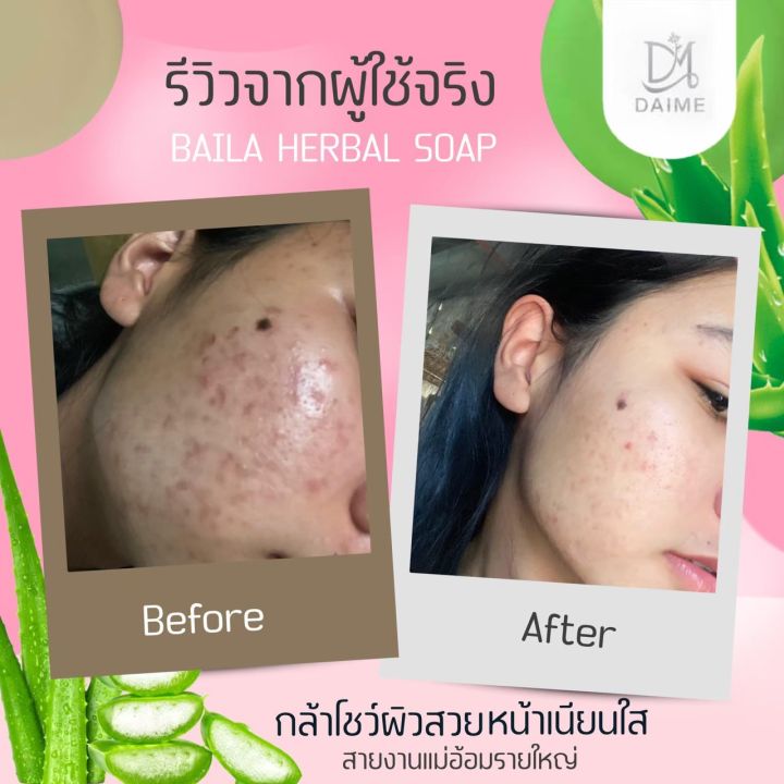 สบู่เอินไดเม่-ของแท้-30g-ก้อนเดียว-ตอบโจทย์-ทุกปัญหาสิว-สิวอักเสบ-สิวผด-สิวสเตียรอยด์-ผิวติดสาร-อย่าปล่อยให้สิวทำลายควมมั่นใจ