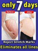 Stretch Mark Remover Permanent Stretch Mark Remover stretch marks remove scars Stretch Mark Tunnel Effective Stretch Mark Cream