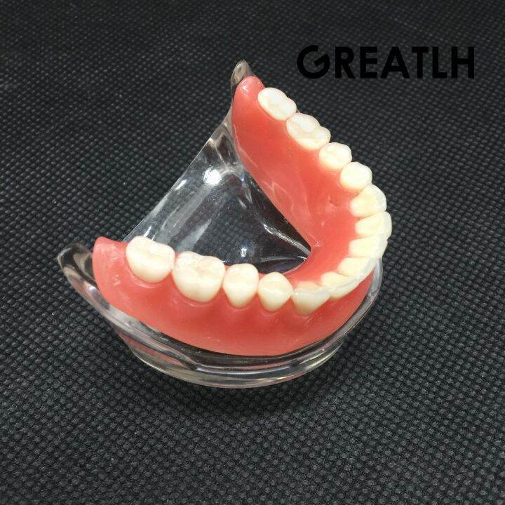 dental-overdenture-interior-mandibular-lower-teeth-model-mandibular-with-implant-restoration-tooth-dental-teaching-study