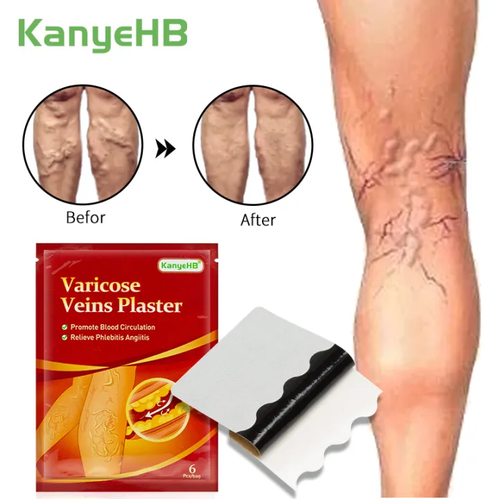 COD Varicose veins sticker soreness and swelling blue veins bulge Blood