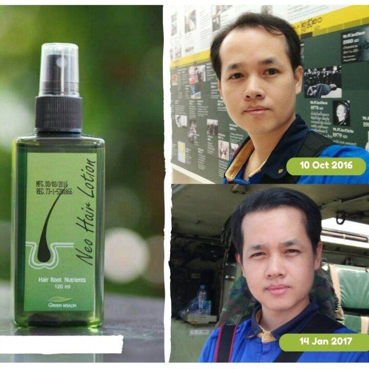 Neo Hair Lotion original Lazada