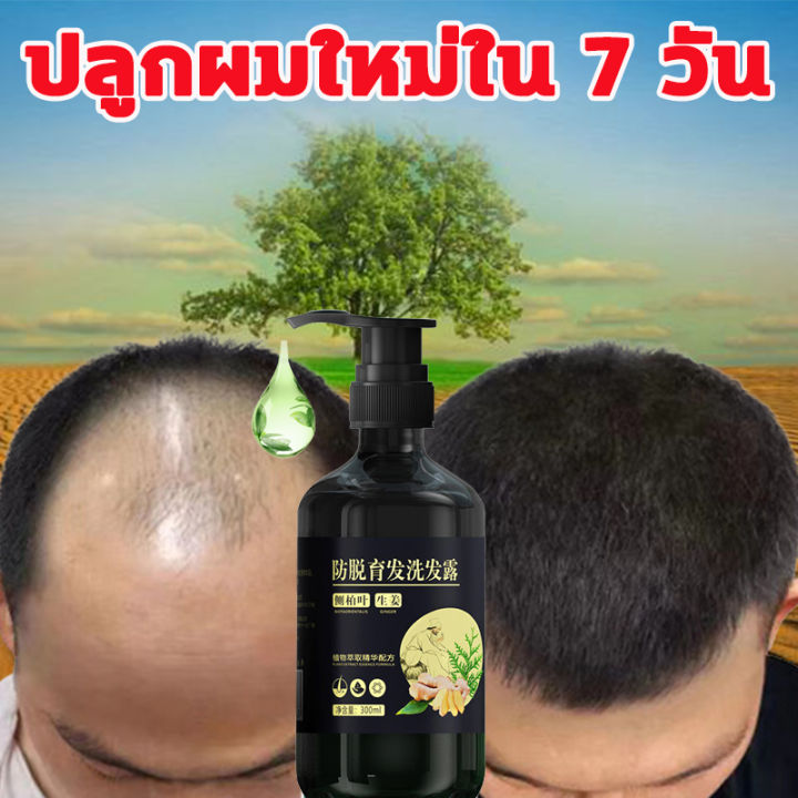 zhenxiu-แชมพูขิง-300ml-แชมพูแก้ผมร่วง-แชมพูขิงของแท้-แชมพูลดผมร่วง-แชมพูเร่งผมยาว-แชมพูปลูกผมดก-แชมพูขจัดรังแค-ยาสระผม-แชมพูสระผม-ยาสระผมแก้ร่วง-ยาสระผมเร่งยาว-แชมพูขิงเพียว-shampoo