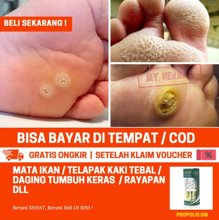 Obat Mata Ikan Di Kaki Dan Tangan Menahun Pengelupas Bobotoleun Secara