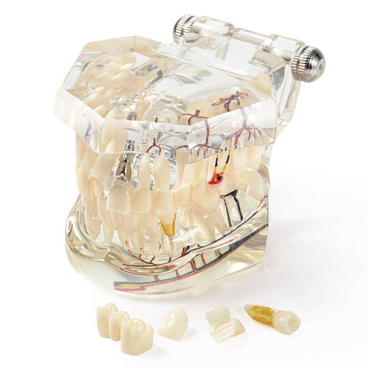 Dental Teaching Model - Single Piece Implant & Bridge Demonstration Tooth With Brackets 5 thumbnail image