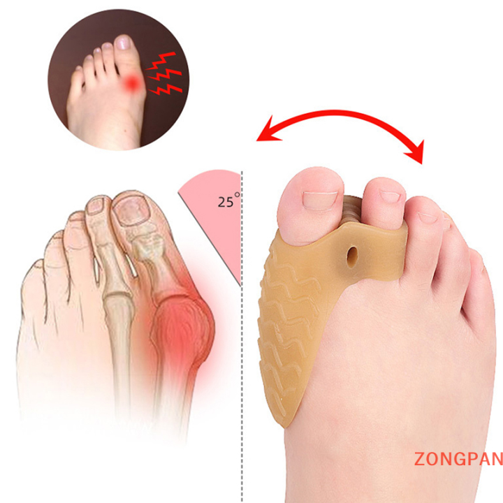 zongpan-เครื่องหนีบนิ้วเท้าขนาดใหญ่-thumb-valgus-protector-ซ้อนทับเครื่องคั่นนิ้วเท้าลูกฟูก