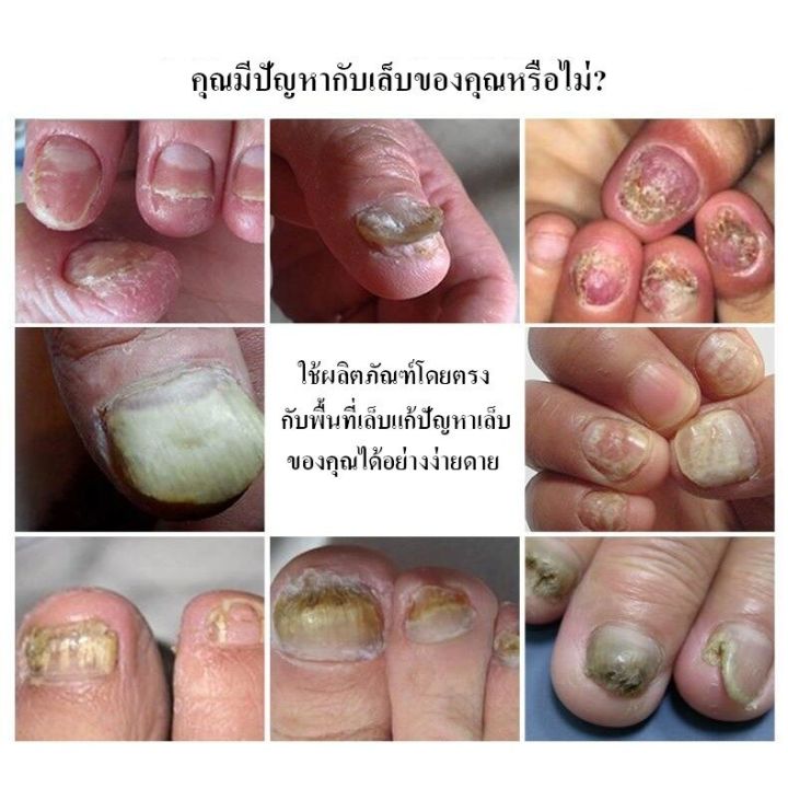 เห็นผลภายใน7วัน-rtopr-รักษาเล็บ-เล็บเท้าคุณภาพสูงกำจัดเชื้อราที่เล็บ-เอ็สเซ้นซ่อมแซมเล็บเสีย-รักษารคเชื้อราที่เล็บ-เล็บพัง-เล็บขบ-เซรั่มบำรุงเล็บ-น้ำมันบำรุงเล็บ-ดูแลเล็บ-เชื้อราเล็บมือ-น้ำยารักษาเล็บ