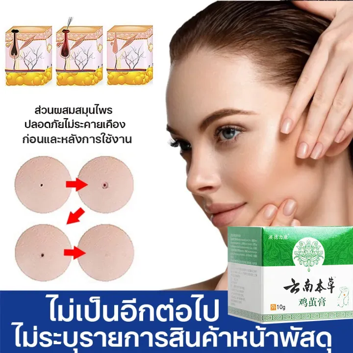 ขี้แมลงวัน-หูดตาปลาและติ่งเนื้อ-ของแท้-corns-warts-removal-พร้อมส่ง-ไฝ-ครีมแต้มหูด-ลอกหูดตาปลา-ปลอดภัยไม่เจ็บ