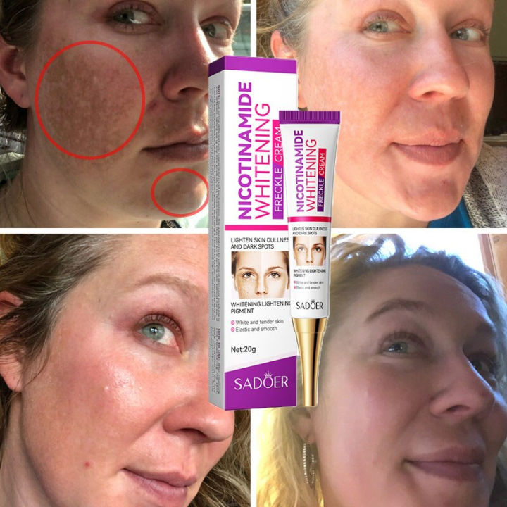 Whitening Freckles Cream Remove Melasma Dark Spot Lightening Melanin Removal Melasma Remover