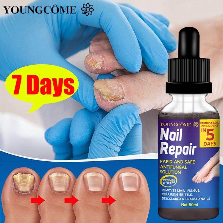 Nail Repair Essence Nail Fungus Treatment Cure Damaged and Fungal Foot Hand Foot Care Lazada PH
