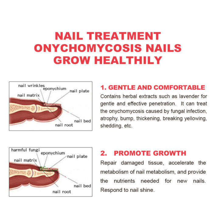 สารสกัดจากเชื้อราที่เล็บเล็บเท้าเท้าดูแลป้องกันการติดเชื้อผลิตภัณฑ์เจลกำจัดเชื้อราเล็บ-paronychia