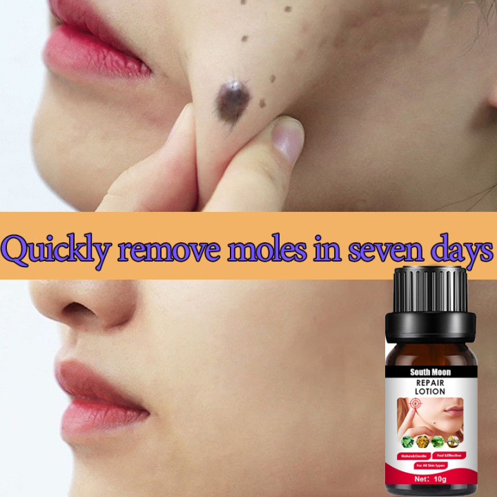 Warts Rover Pure Kasoy Oil Mole And Skin Tag Remover Lazada