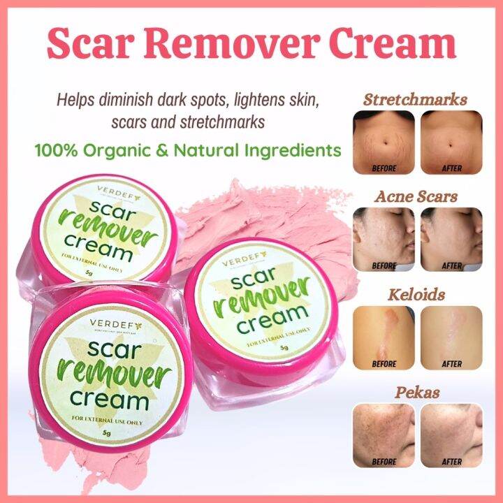 COD support Korean beauty Keloid Stretch mark Remover Cream Scar