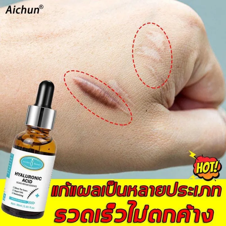 Aichun ครีมลบแผลเป็น 30ml ครีมลดรอยแผล เจลลบรอยแผลเป็น ครีมทาแผลเป็น ครีมลบรอยแผลเป็น แผลน้ำร้อน