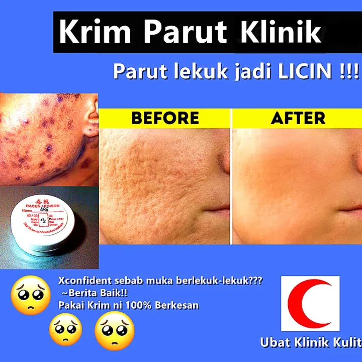 Krim Parut Jerawat Lekuk Dari Klinik Kulit 100 Berkesan Dan Halal Acne Scar Cream Jerawat Berlubang Box Scar Ice Prick Lazada