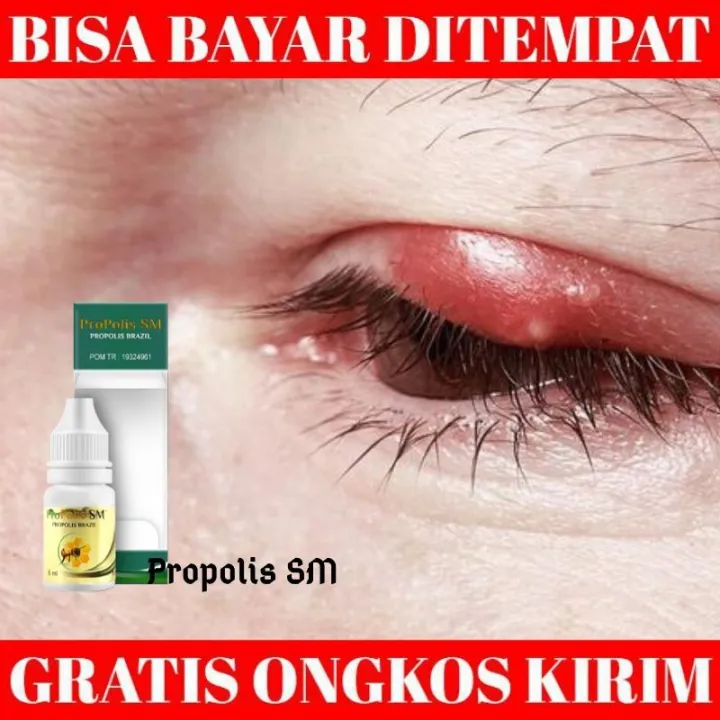 Obat Bintitan, Bintitan Di Bawah Mata, Mata Bintitan, Bintitan Mata ...