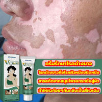 ?7วัน เห็นผล?South Moon ครีมทาด่างขาว 20g สารสกัดจากสมุนไพร ไม่ระคายเคือง ใช้ได้ทั้งร่างและทุกวัย ผลิตภัณฑ์กระตุ้นการสร้างเม็ดสีของผิว โรคด่างขาว โรคผิวหนัง ผลิตภัณฑ์ Vitiligo ด่างขาวที่หน้า ด่างขาวที่หลัง ด่างขาวที่แขน ด่างขาวที่ขา ยาด่างขาว