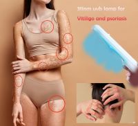 Home UVB Lamp Phototherapy 311Nm Narrow Band For Vitiligo Psoriasis Treatment 311Nm Psoriasis Laser Uv Treatment