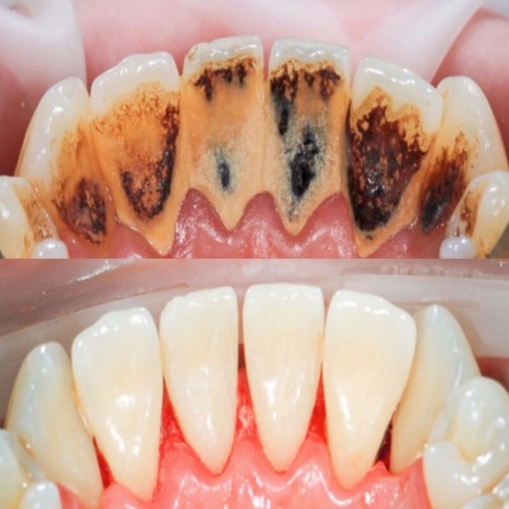 ยาสีฟันไวท์เทนนิ่ง-ยาสีฟันโปรไบโอติก-ยาสีฟันลมหายใจสดชื่น-ยาสีฟันไวท์เทนนิ่ง-ทำความสะอาดคราบสีเหลือง-ยาสีฟันนิ่ว-ป้องกันกลิ่นปากเหงือก