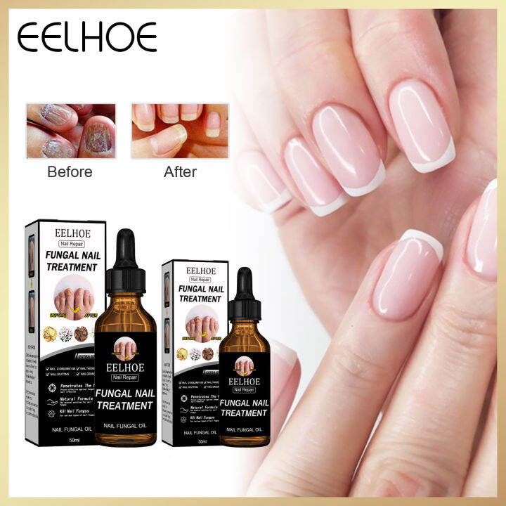 EELHOE Nail Repair Essence Toenail Fungus Treatment Liquids Paronychia