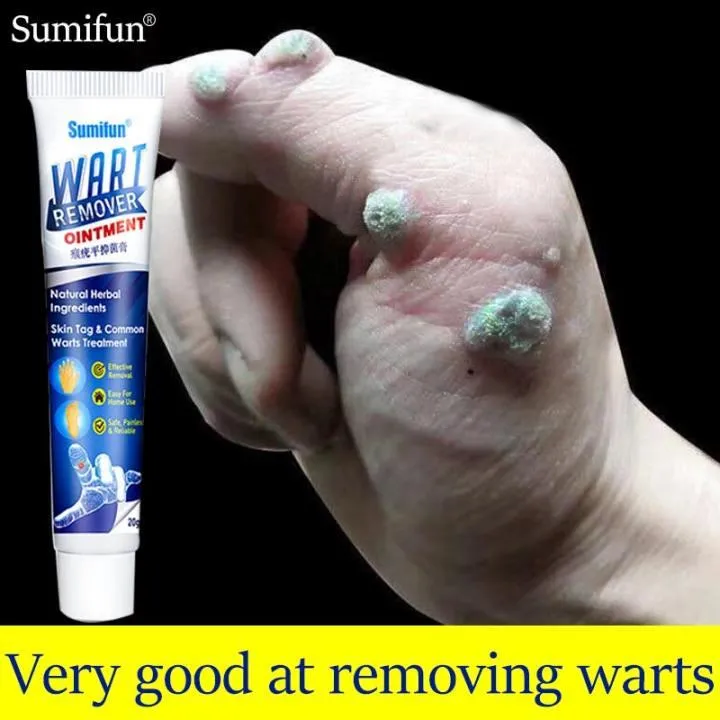 20g Sumifun Wart Removal Cream ointment medical Foot health care