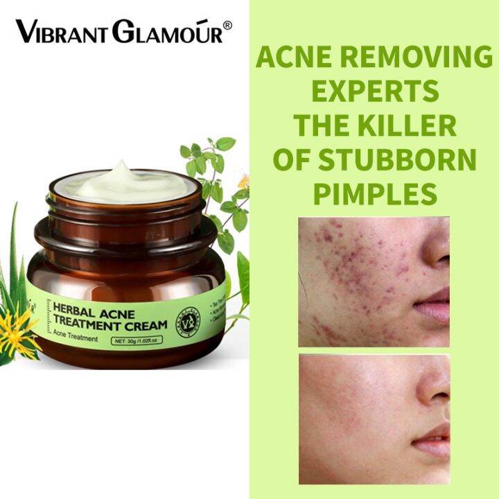 Acne Treatment Cream Acne Removal Cream AntiAcne Clear Pimples remover