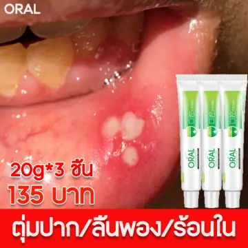 ยาป้ายแผลในปาก ราคาถูก ซื้อออนไลน์ที่ - พ.ย. 2023 | Lazada.Co.Th