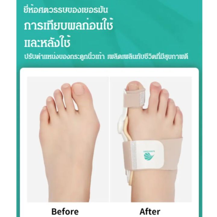 acurve-2-ชิ้น-ที่ปรับนิ้วโป้งเท้าล็อก-ที่ปรับนิ้วโป้งเท้าเก