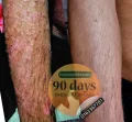 Psoriasis Alternative 90 days Natural Treatment - No drug. No steroid. 