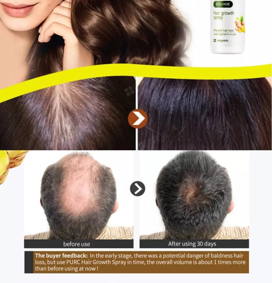 share-124-b12-deficiency-hair-loss-reversible-latest-tnbvietnam-edu-vn